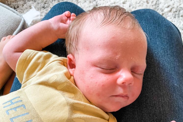 newborn with baby acne