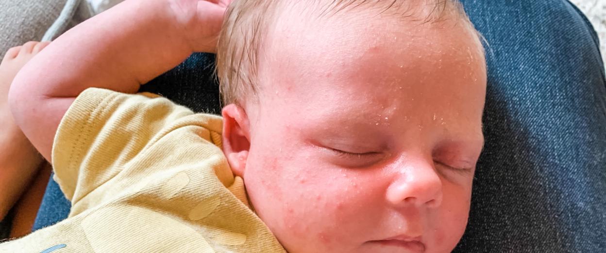 newborn with baby acne